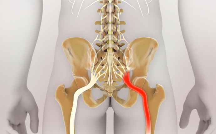 Terävää kipua alaselässä ja jalassa – iskias on yleinen vaiva
