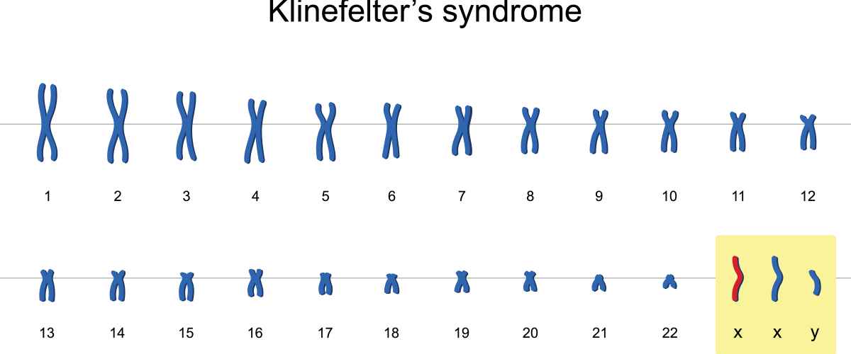 Kielellisen kehityksen puutteet haittaavat Klinefelterin oireyhtymästä kärsiviä poikia