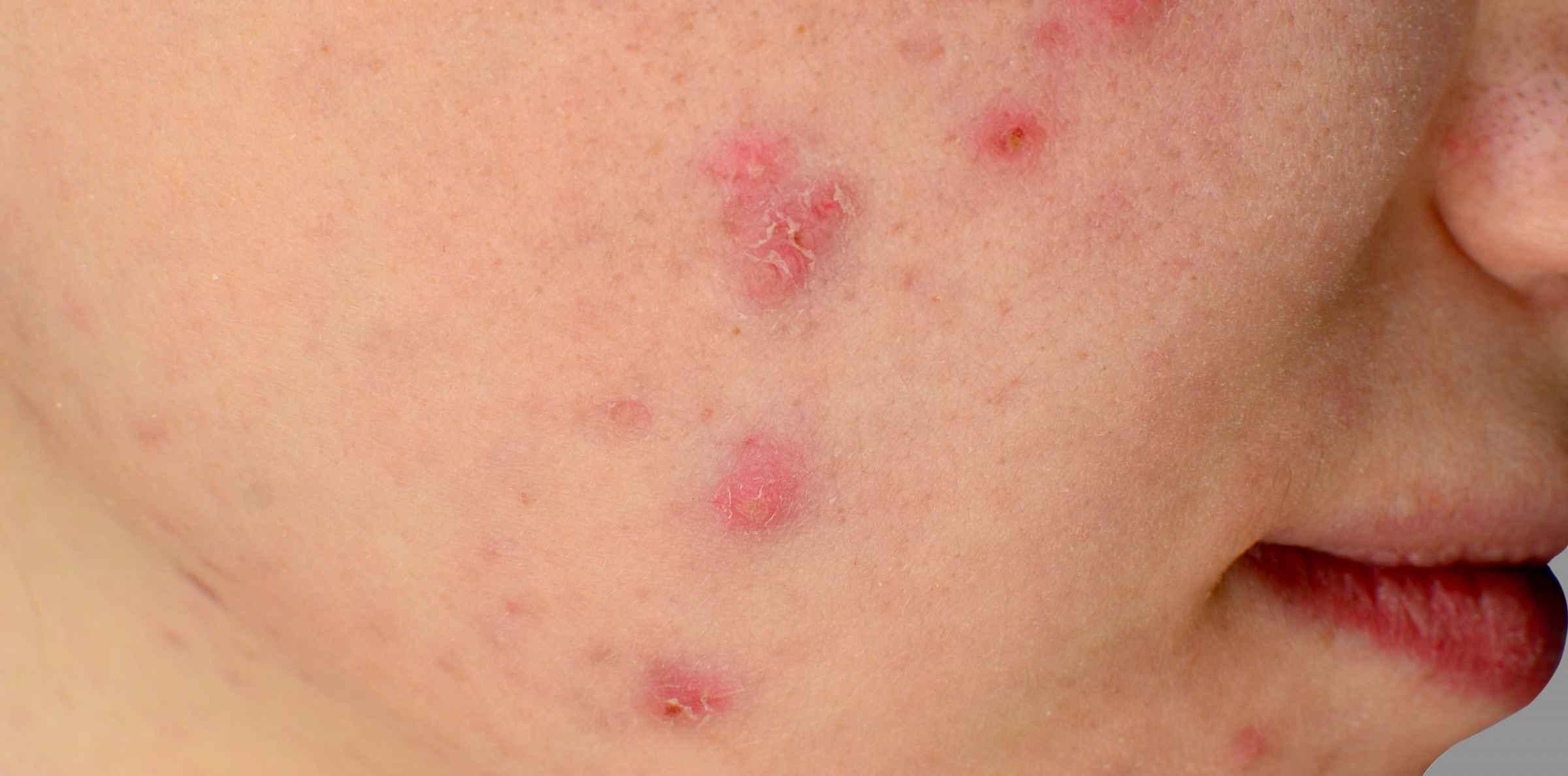 Acne On One Side Of Body